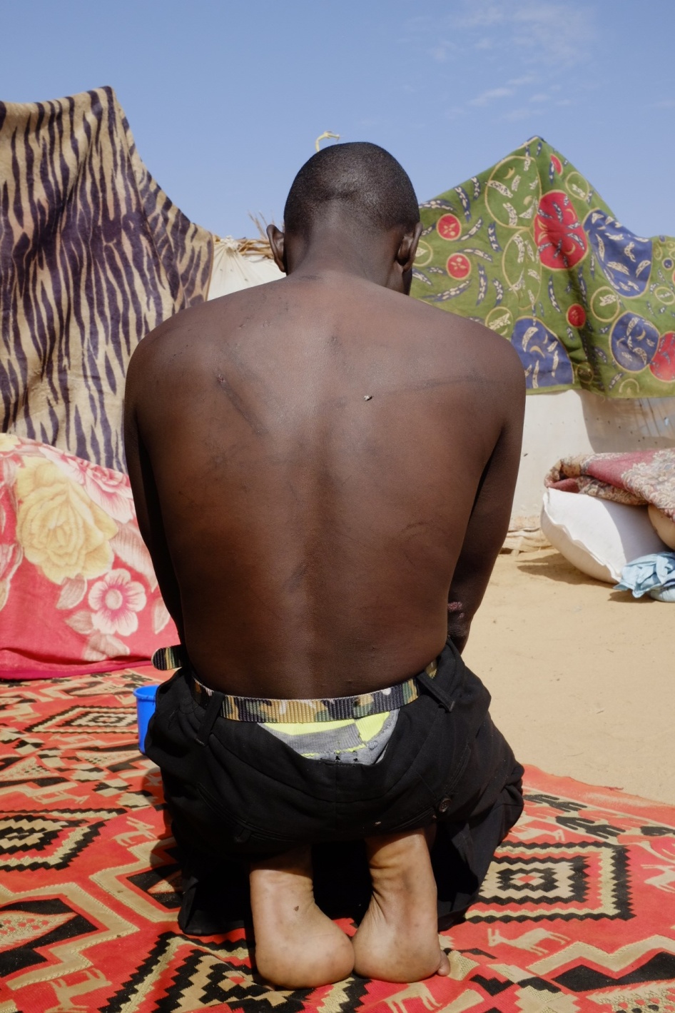 A man displays hi sback injuries 